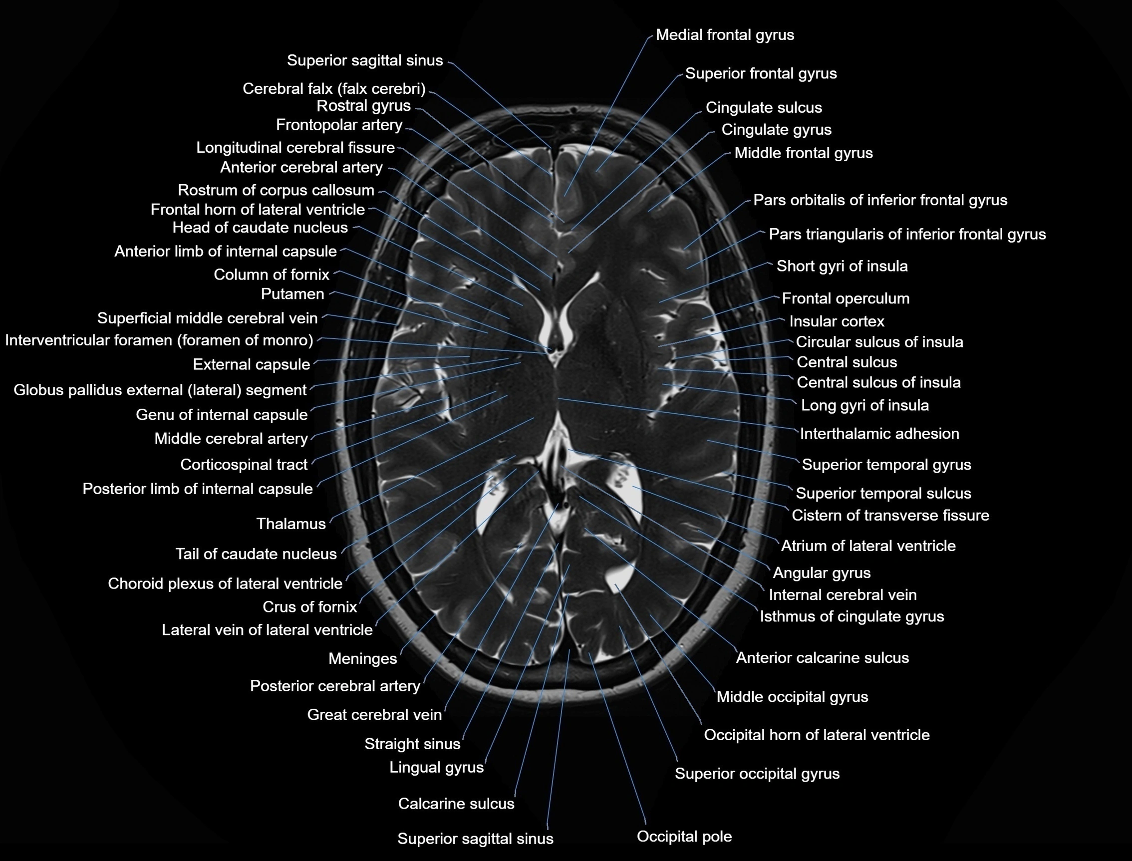MRI Brain axial cross sectional radiology anatomy 3T image  -img-00001-00030.webp